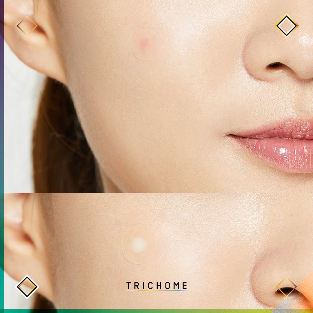 Acne Pimple Master Patch - Trichome Seattle - CosRX - Skin Care